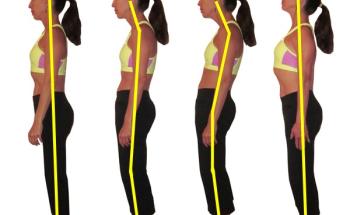 Postural defects are deviations from a correct alignment of the segments body during daily activities.