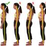 Postural defects are deviations from a correct alignment of the segments body during daily activities.
